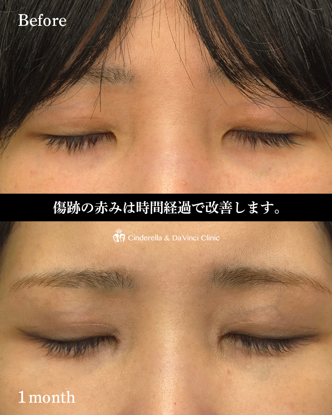 目頭切開のみで離れ目改善の画像