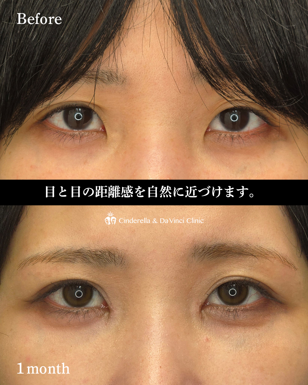 目頭切開のみで離れ目改善の画像