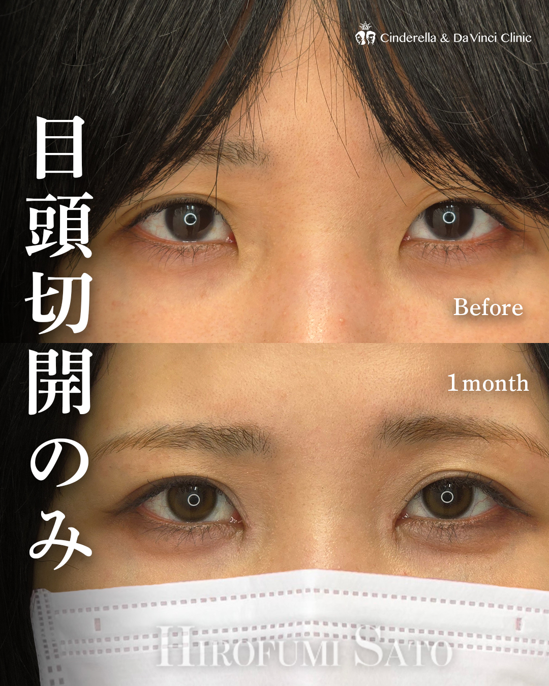 目頭切開のみで離れ目改善の画像