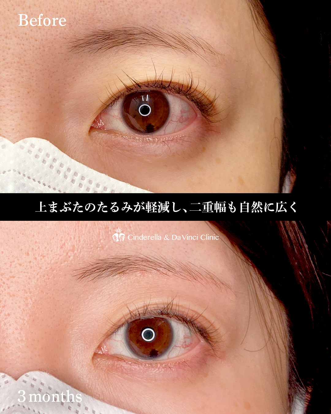 眉下切開でたるみ取りの画像