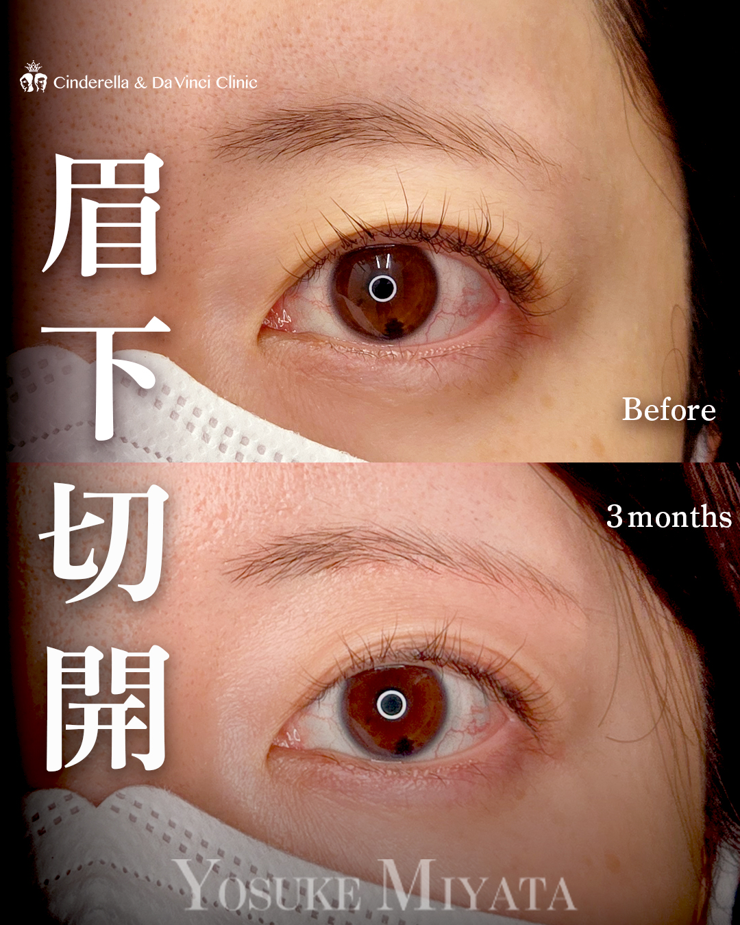 眉下切開でたるみ取りの画像