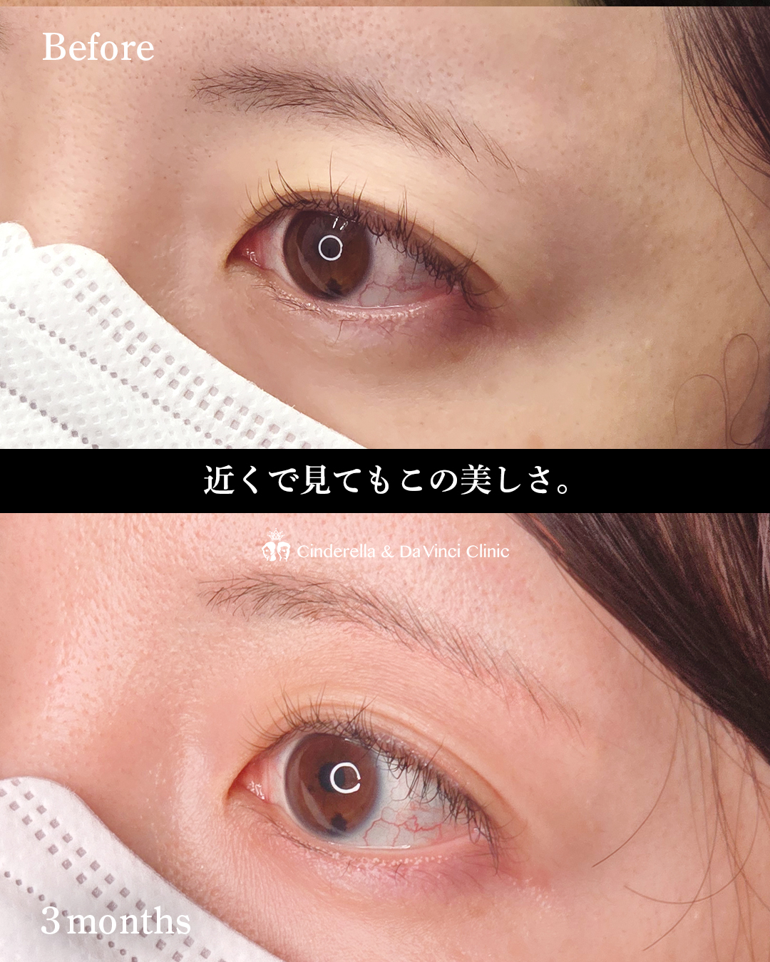 眉下切開でたるみ取りの画像