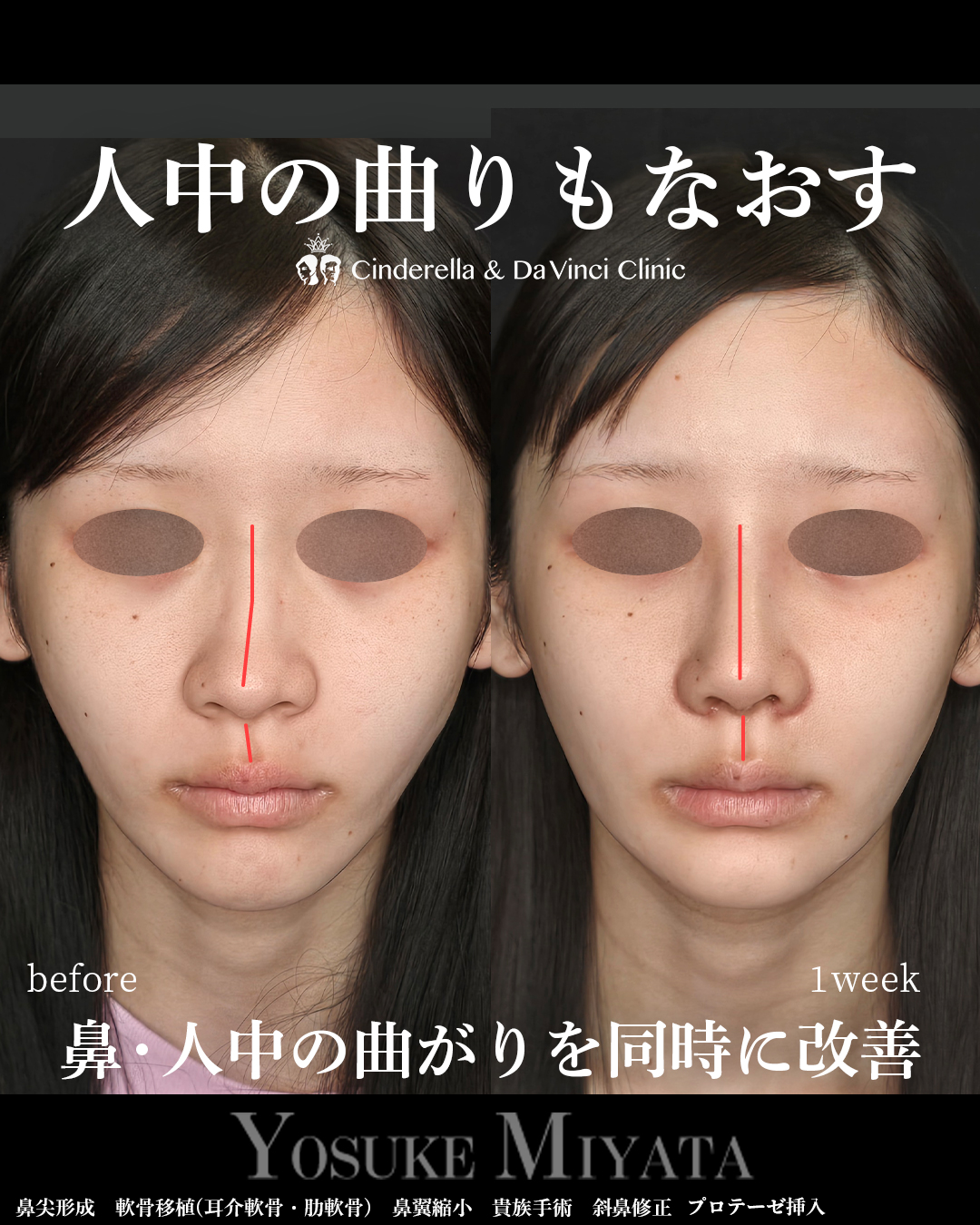 鼻と人中の歪み修正の画像