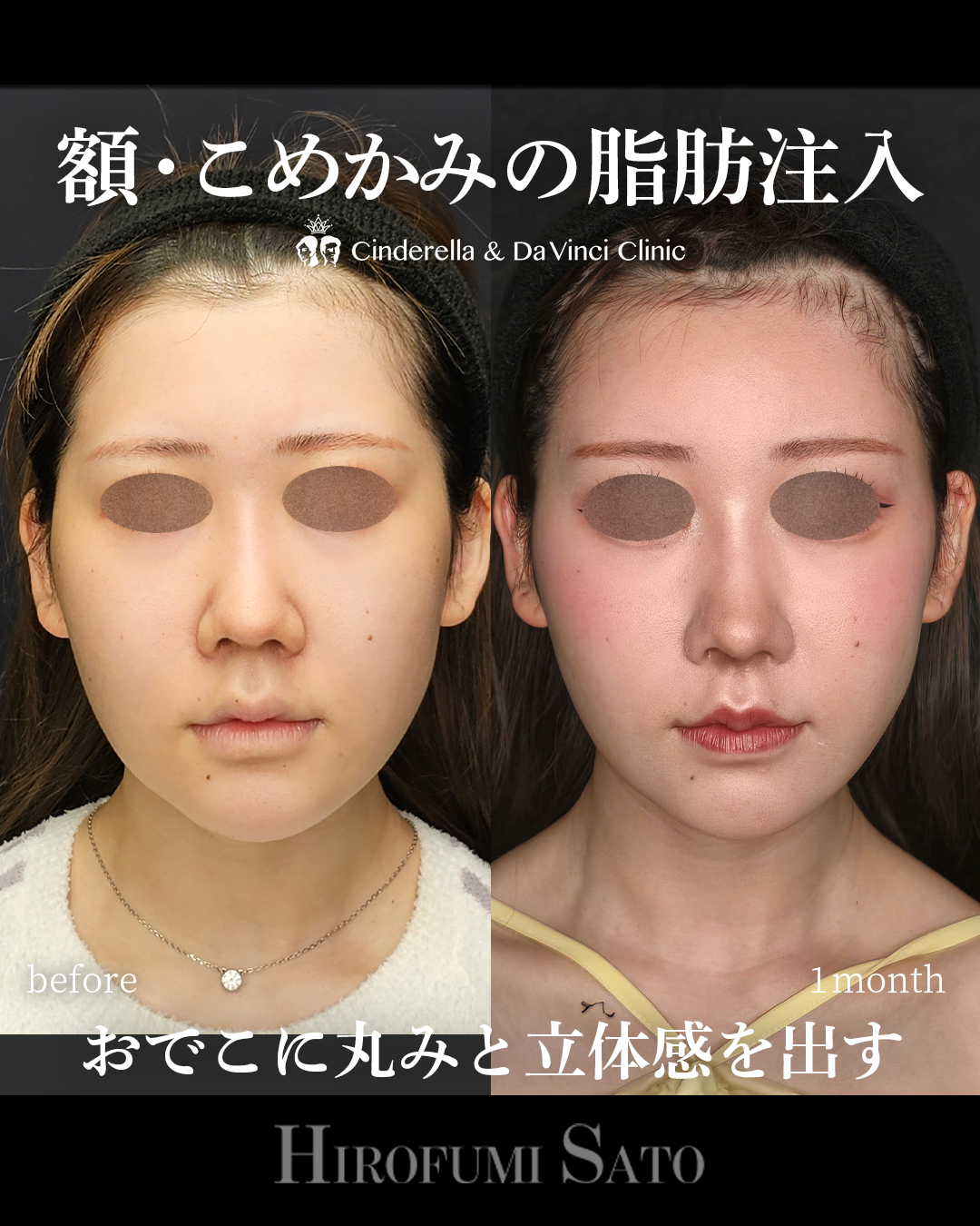 おでこの脂肪注入の画像