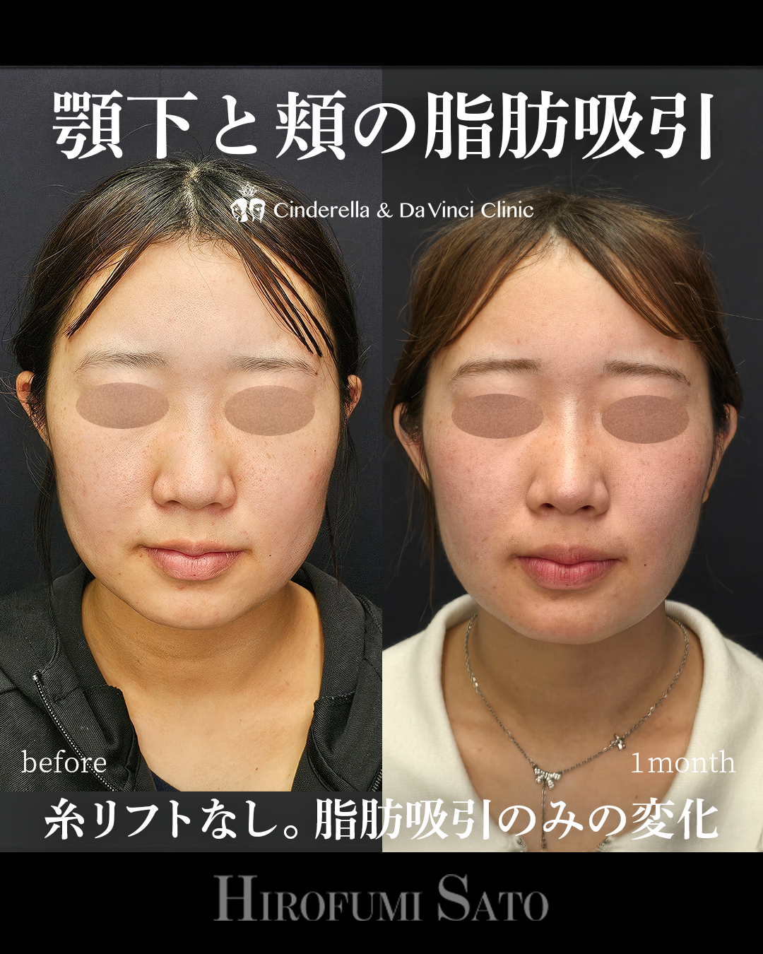 輪郭の脂肪吸引のみの画像