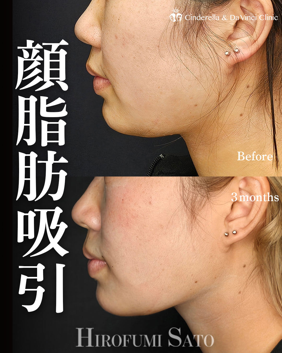 輪郭の脂肪吸引のみの画像