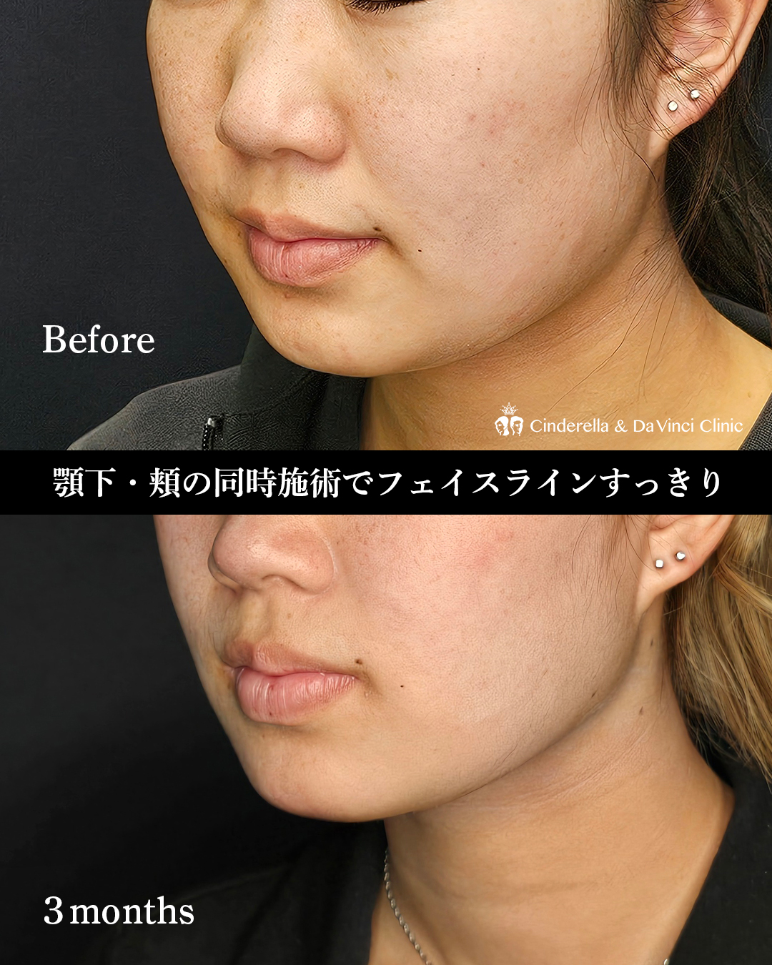 輪郭の脂肪吸引のみの画像