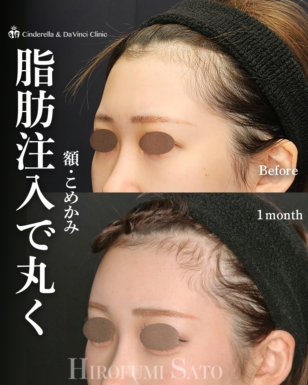 おでこの脂肪注入の画像