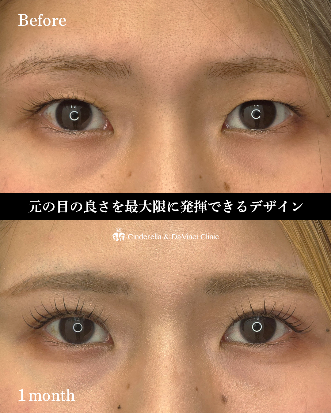 ぱっちり見せる埋没の画像