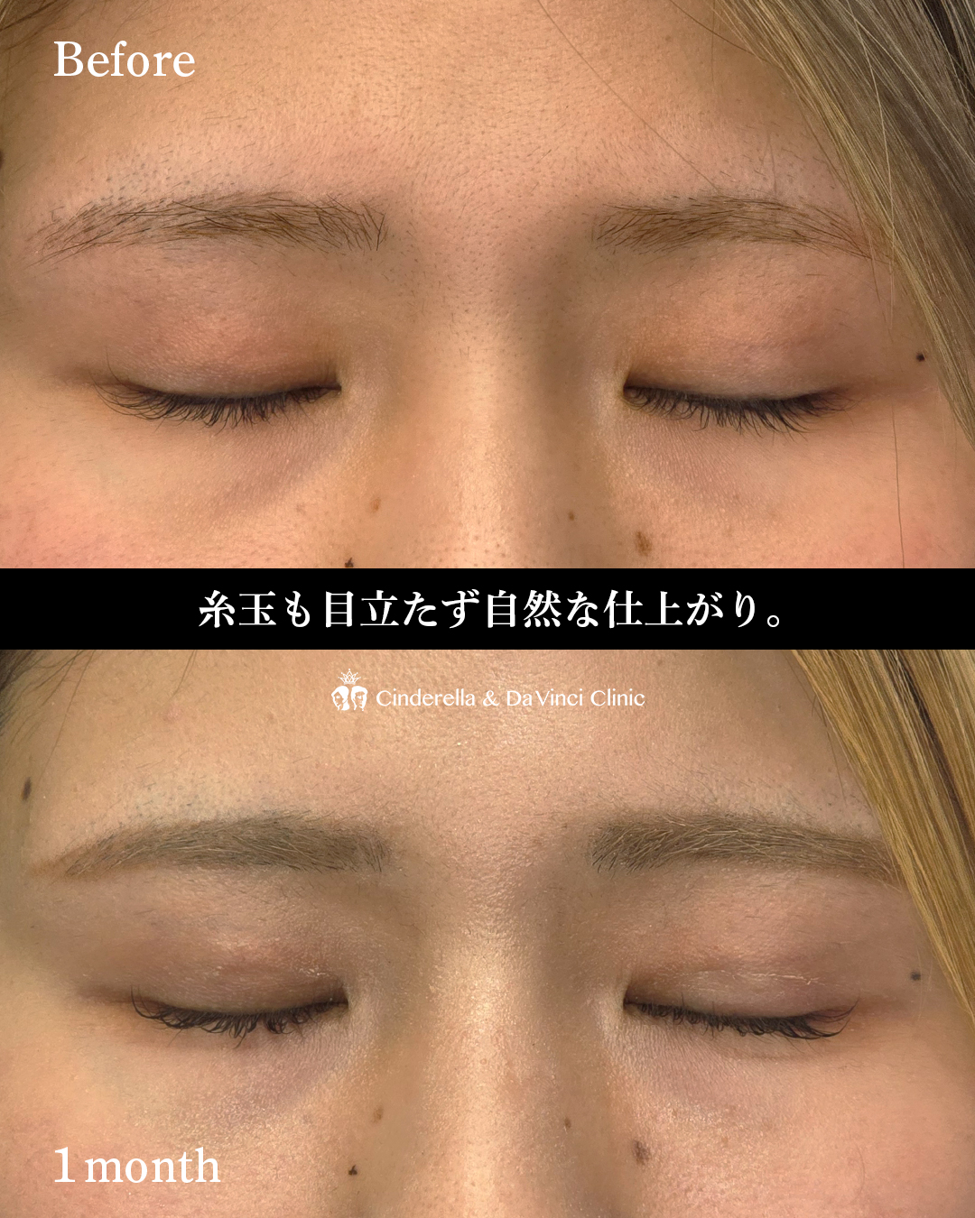 ぱっちり見せる埋没の画像