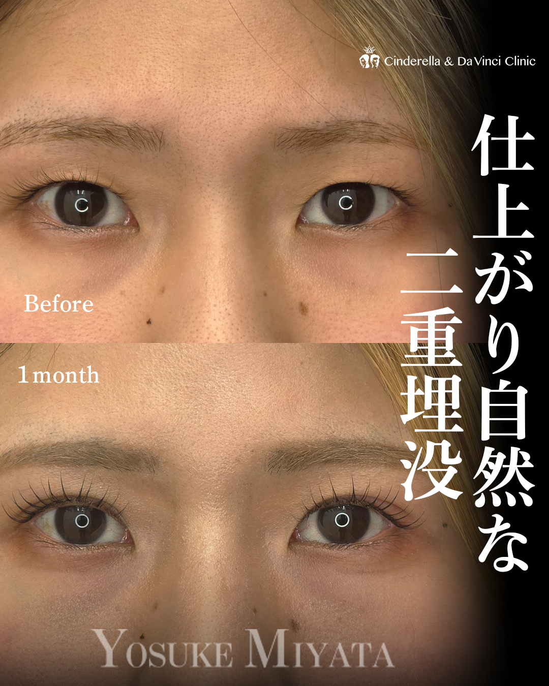 ぱっちり見せる埋没の画像