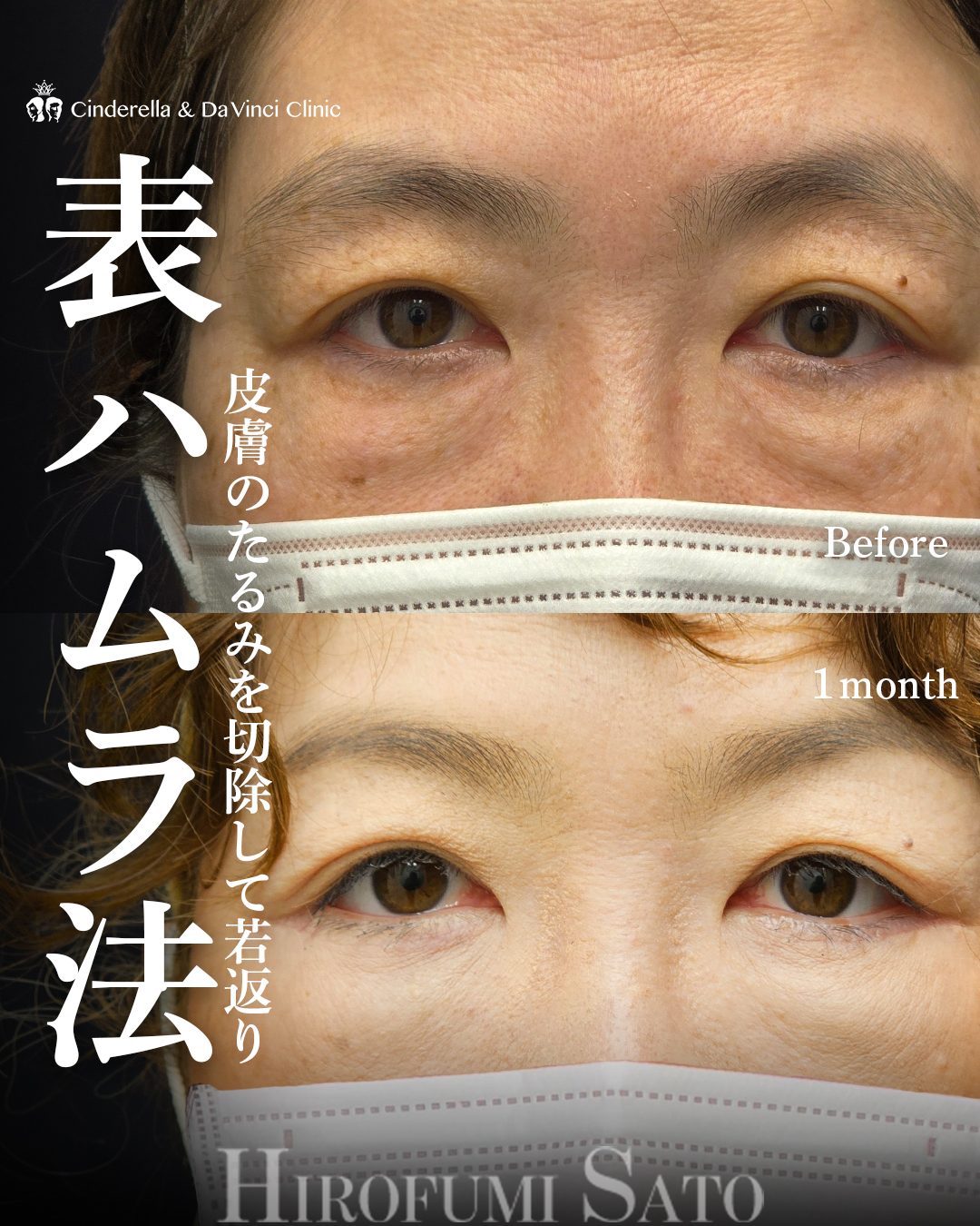 目の下のたるみ切除の画像