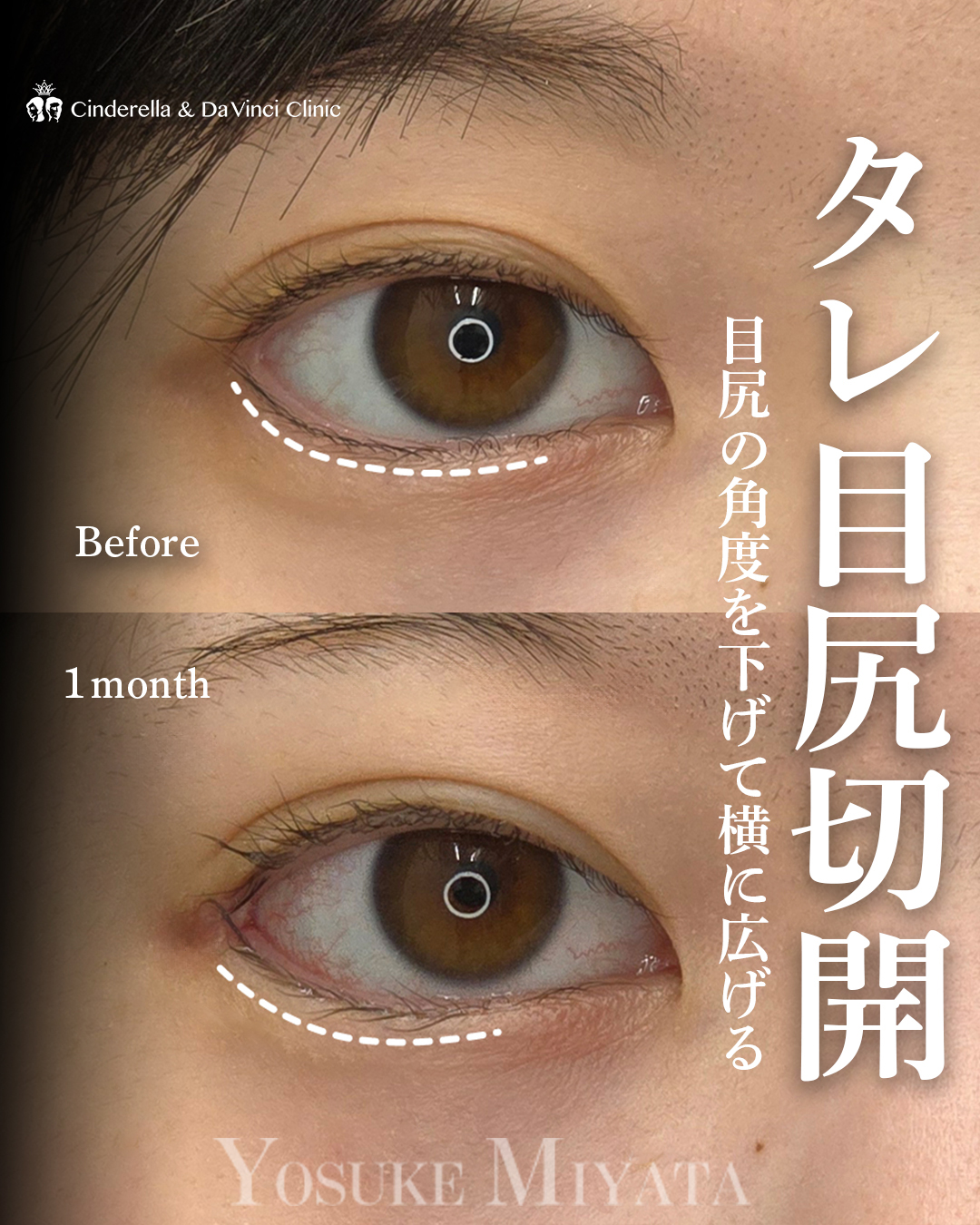 タレ目尻切開の画像