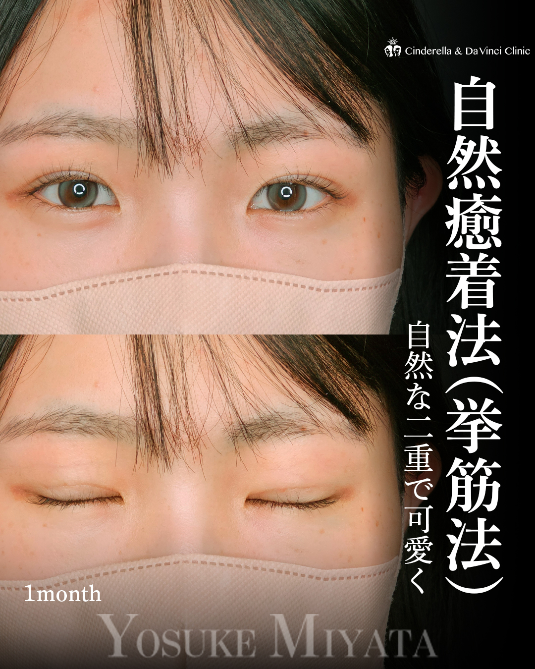 自然で可愛い二重の画像