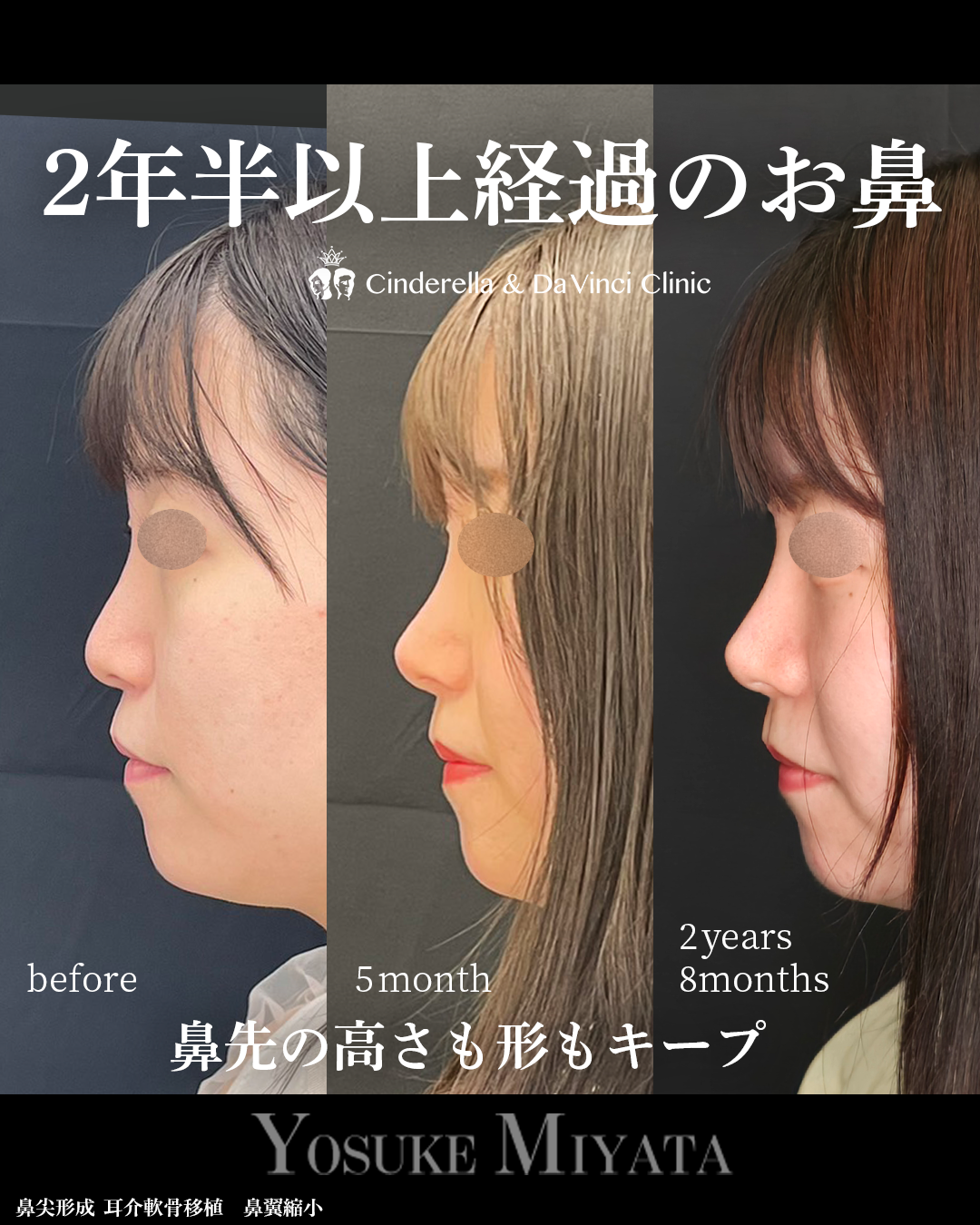 鼻手術後2年半越えの画像