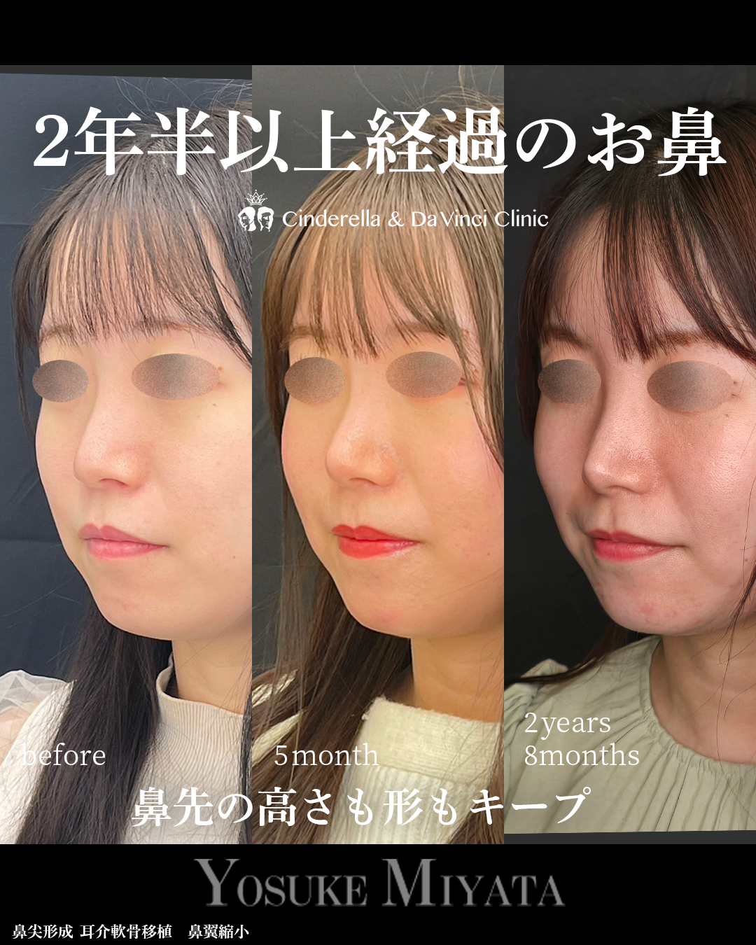 鼻手術後2年半越えの画像