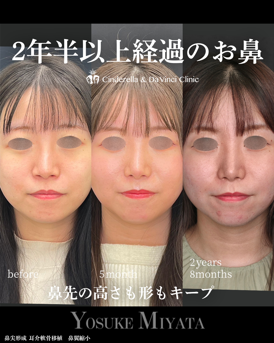 鼻手術後2年半越えの画像