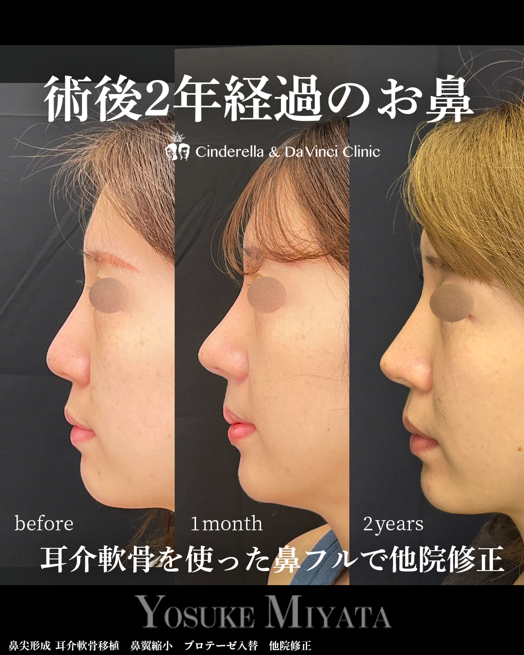 鼻整形の2年後の画像