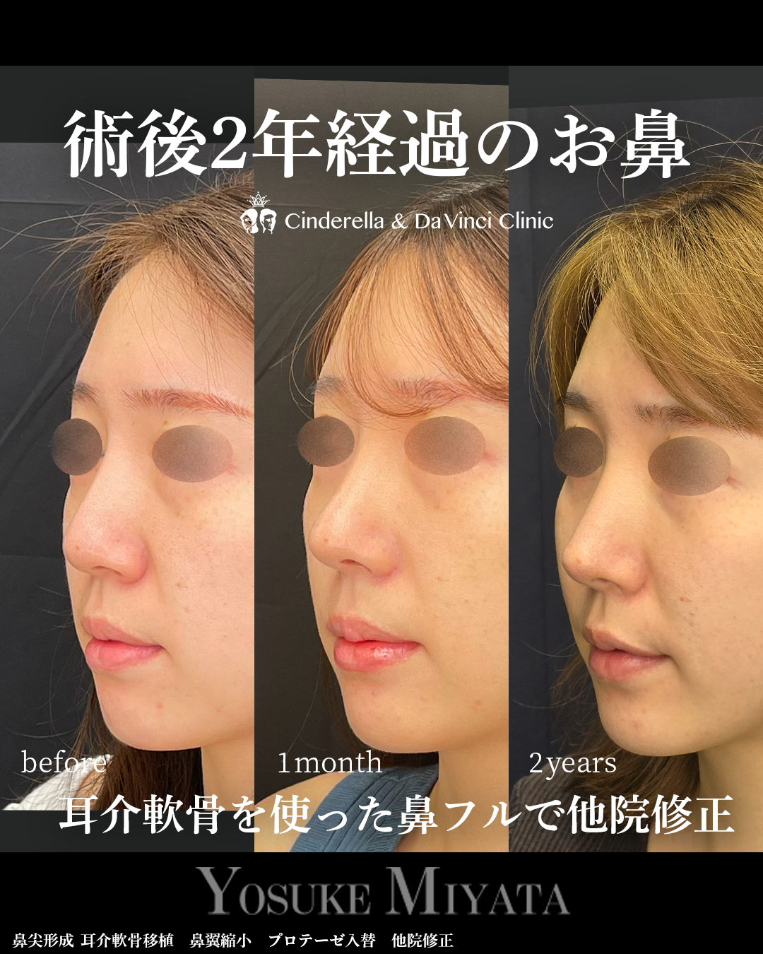 鼻整形の2年後の画像