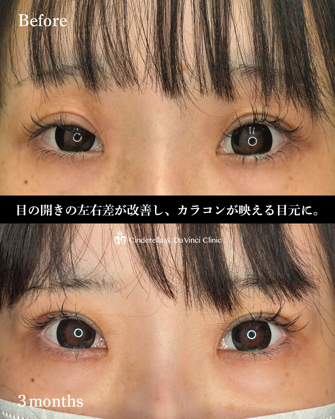眼瞼下垂手術の画像