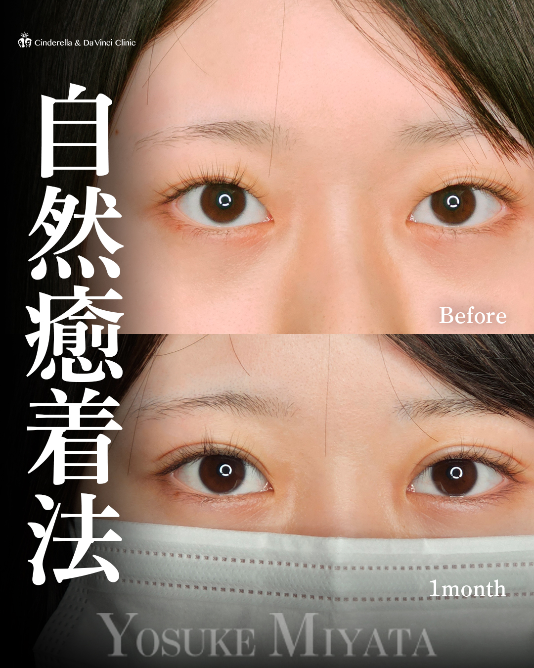 盛れる二重の画像