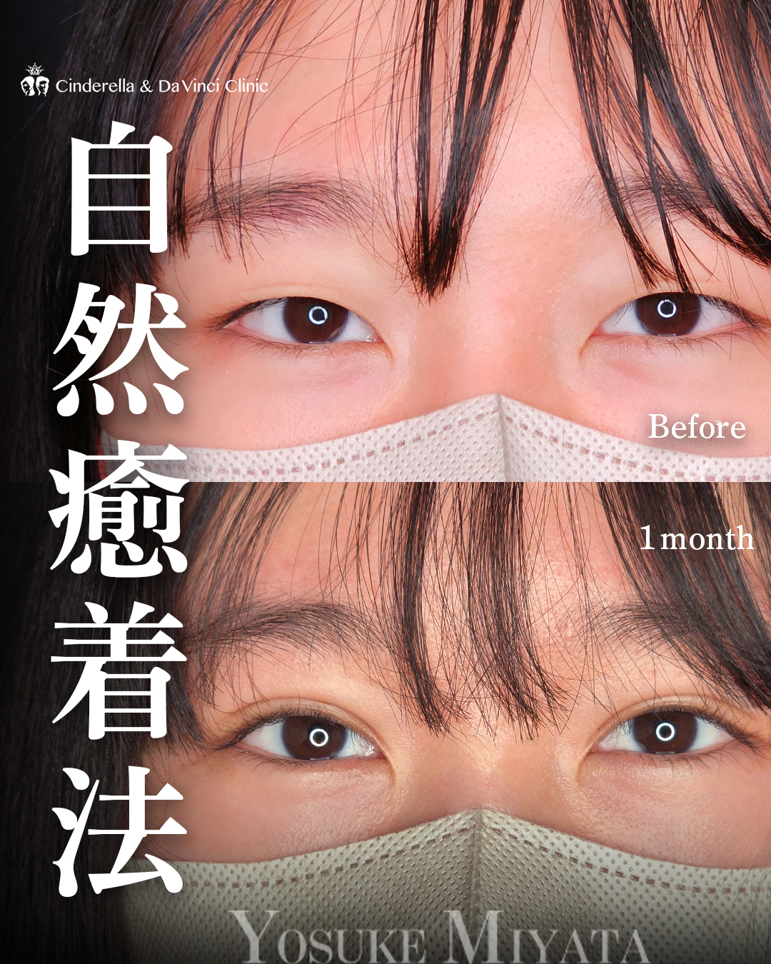 ミックス型の埋没の画像
