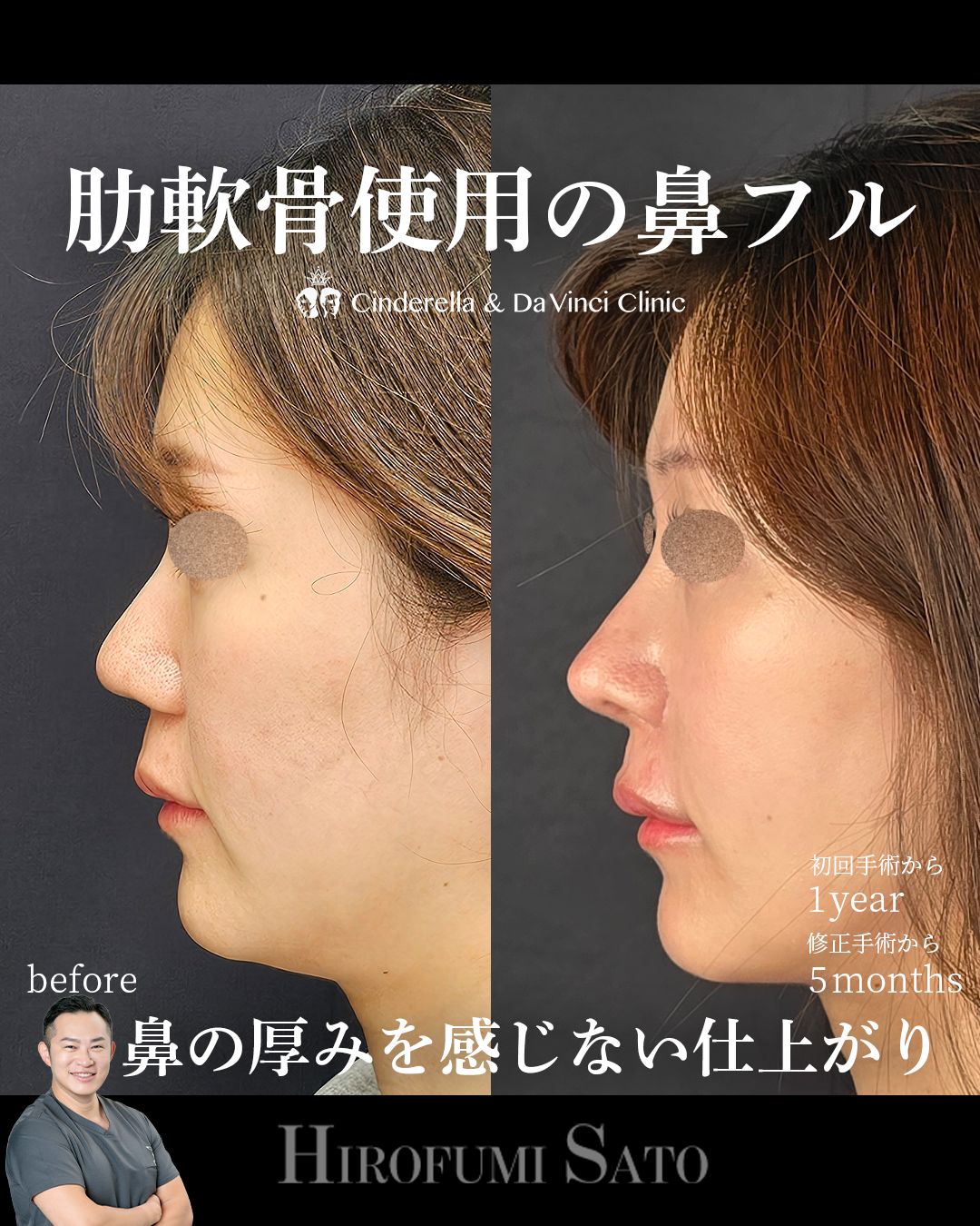 鼻全体を整えるの画像