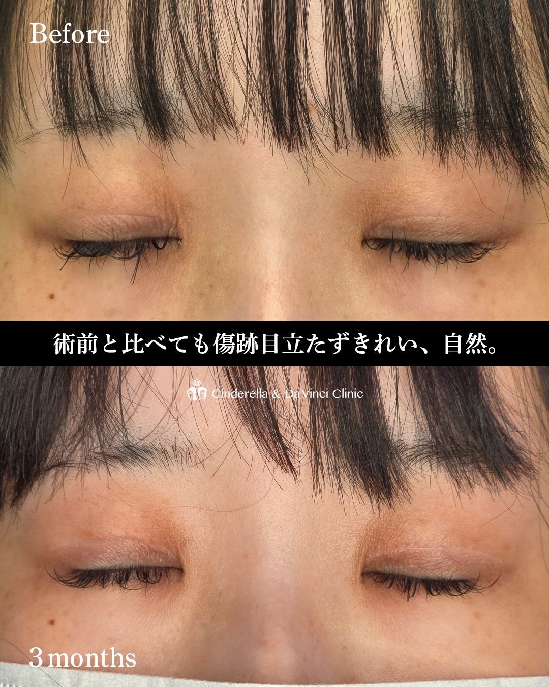 眼瞼下垂手術の画像