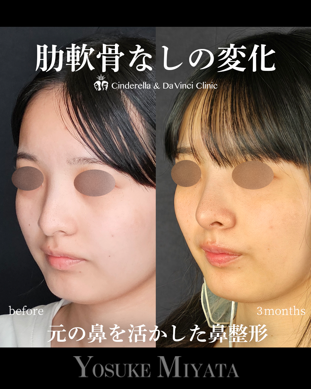 肋軟骨なし鼻整形の画像