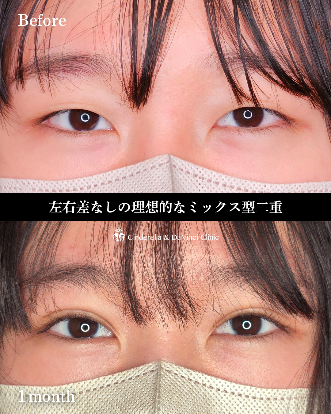 ミックス型の埋没の画像