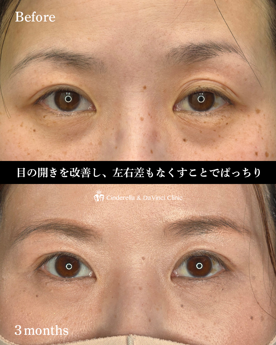 眼瞼下垂手術の画像