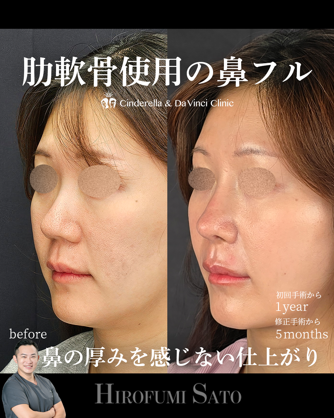 鼻全体を整えるの画像