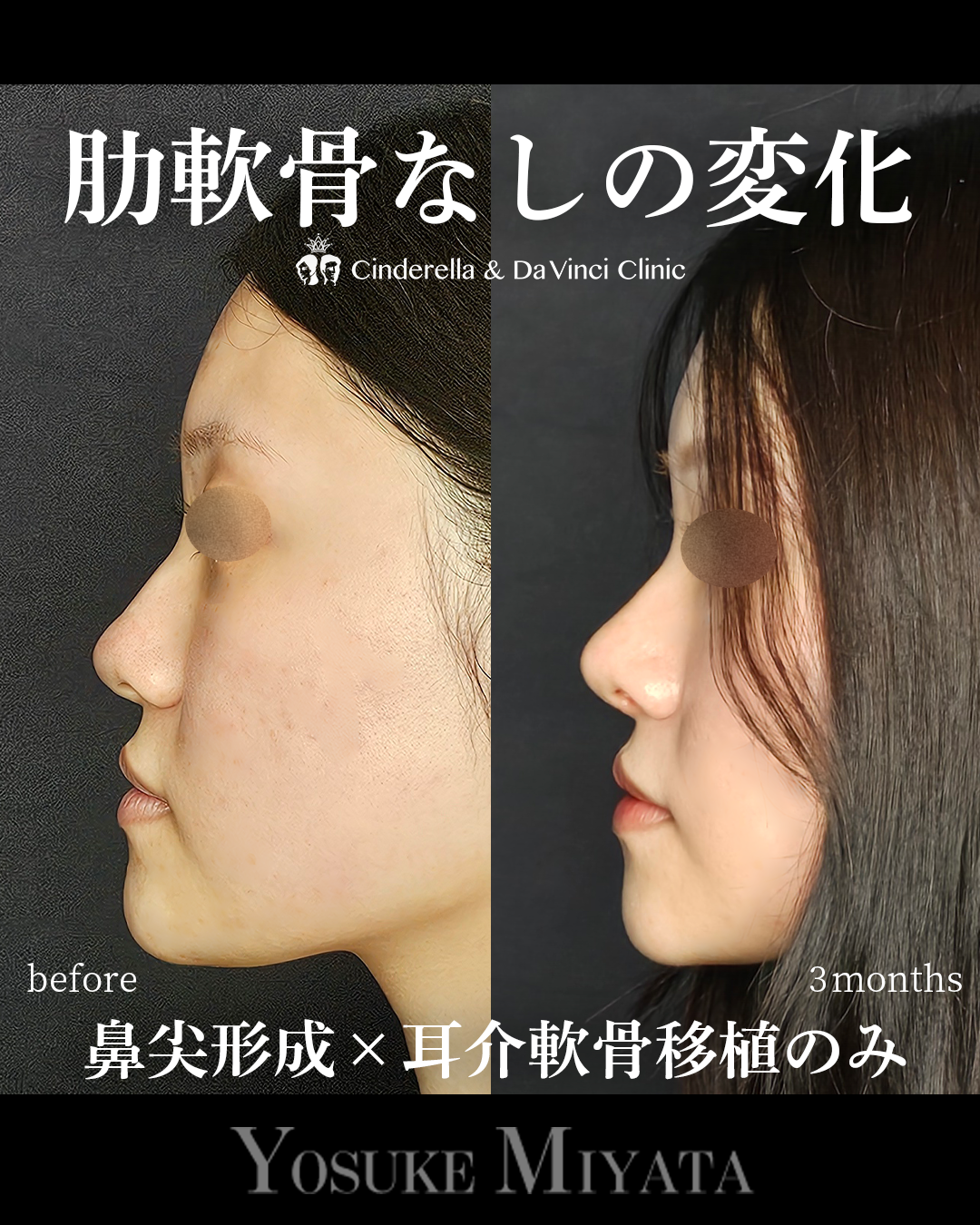 肋軟骨なしの鼻整形の画像