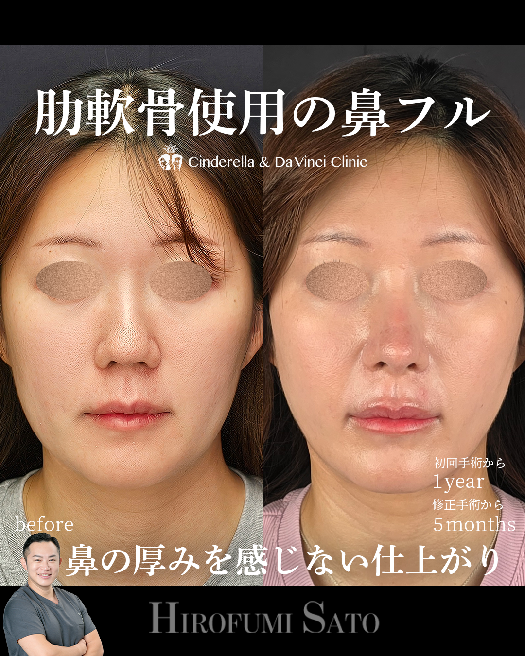 鼻全体を整えるの画像