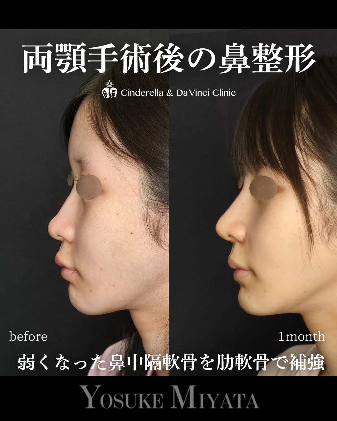 両顎後の鼻整形の画像