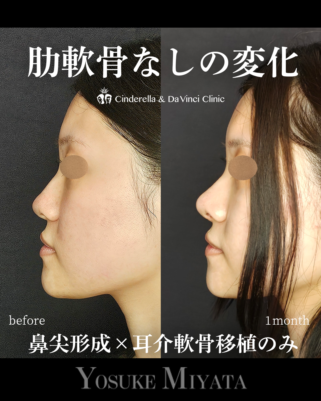 肋軟骨なしの鼻整形の画像