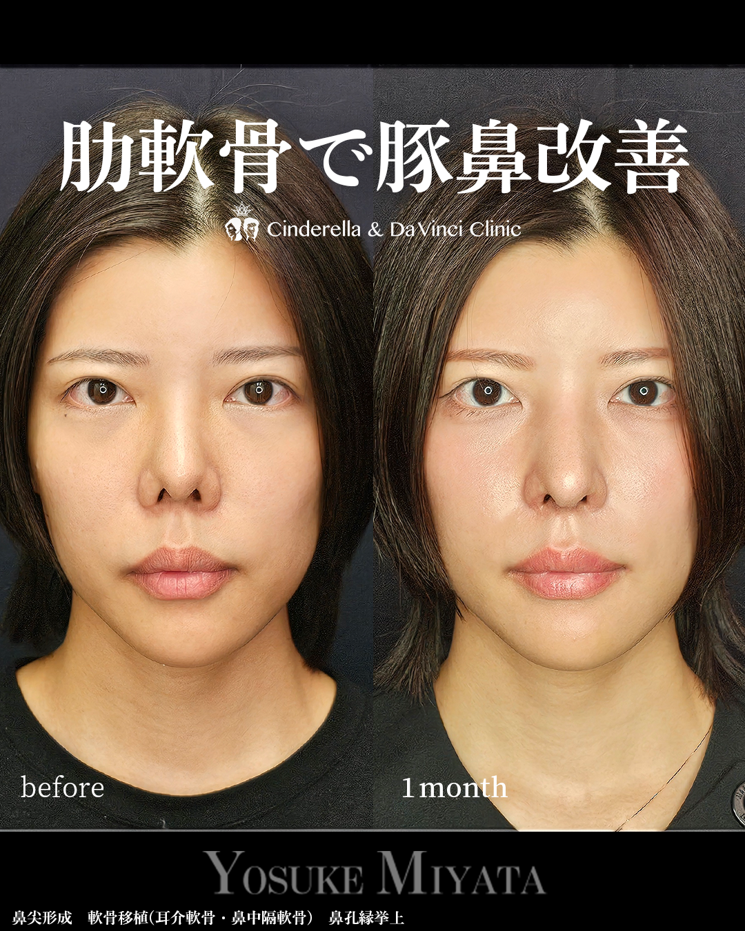 肋軟骨で豚鼻改善の画像