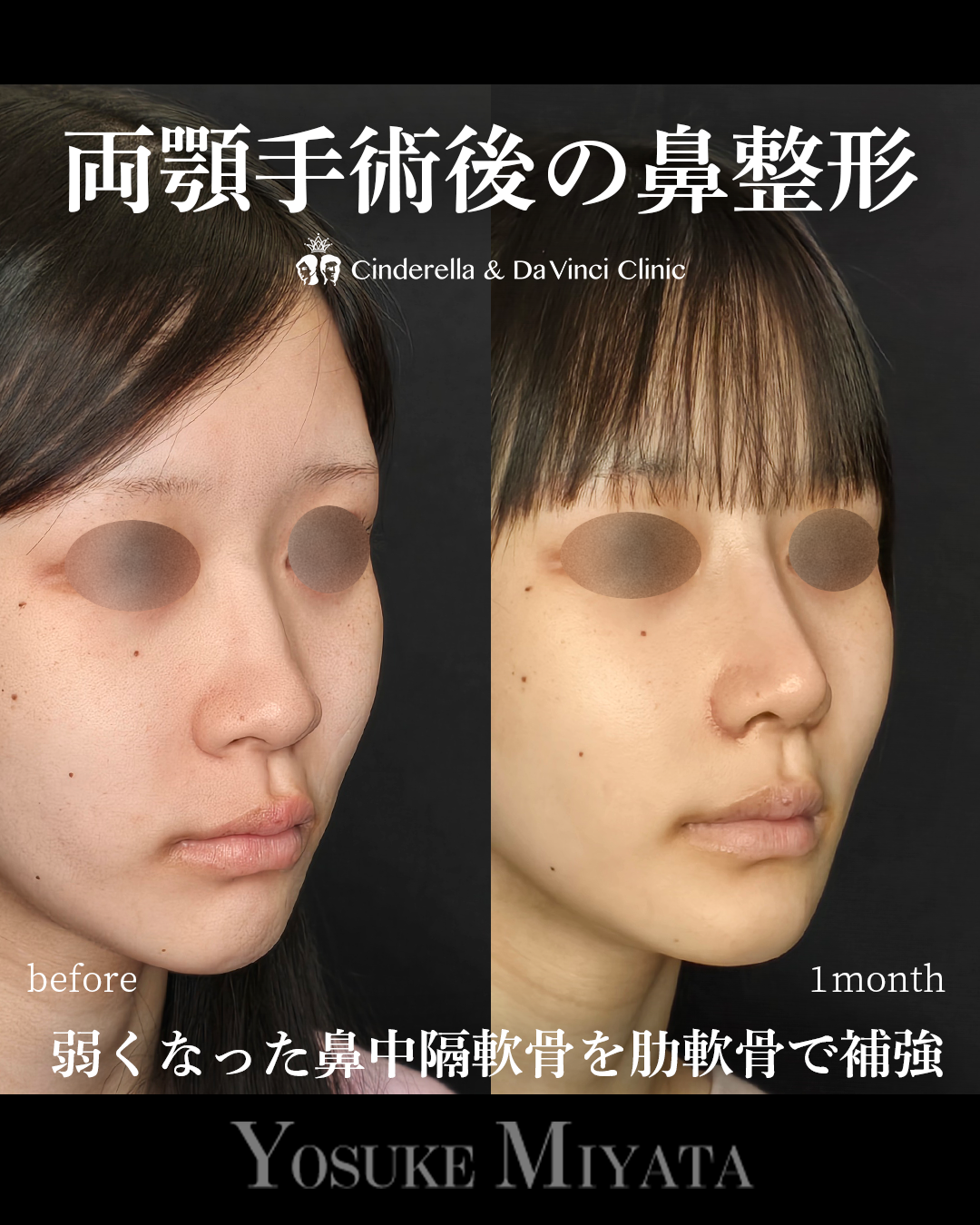両顎後の鼻整形の画像