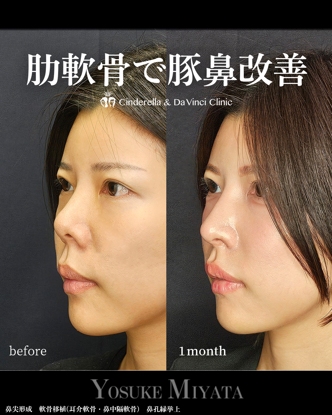 肋軟骨で豚鼻改善の画像
