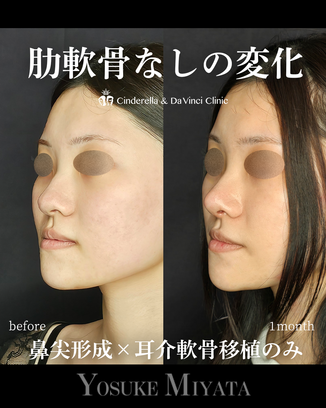 肋軟骨なしの鼻整形の画像