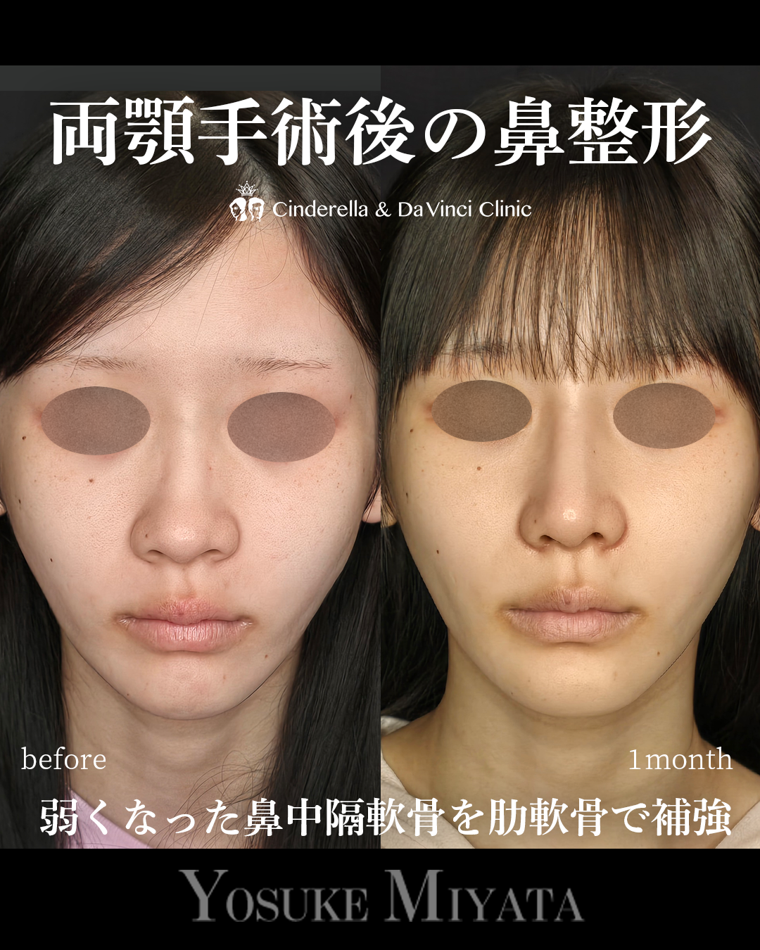 両顎後の鼻整形の画像
