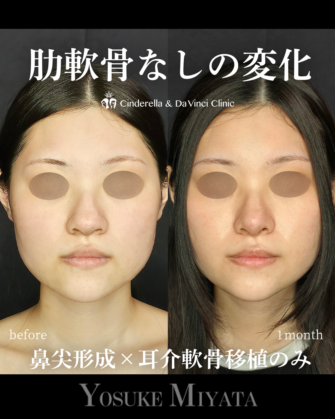 肋軟骨なしの鼻整形の画像