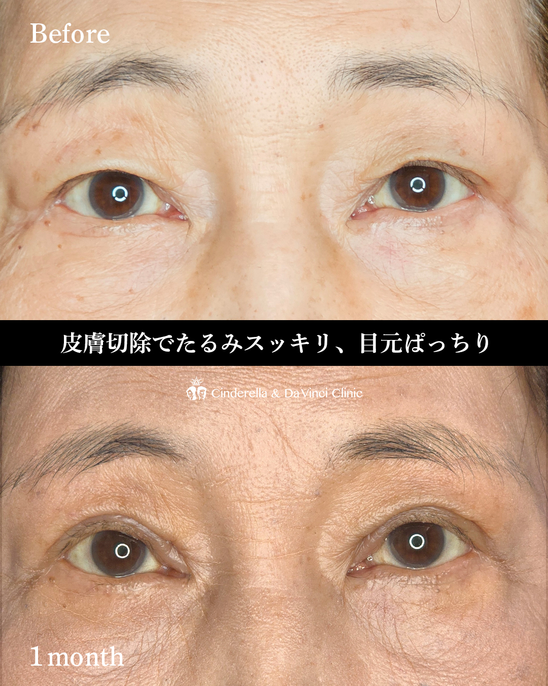 60代の全切開の画像