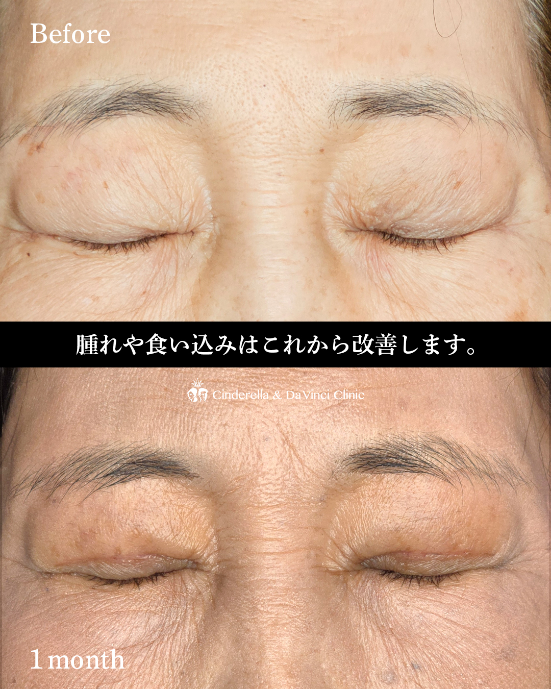 60代の全切開の画像