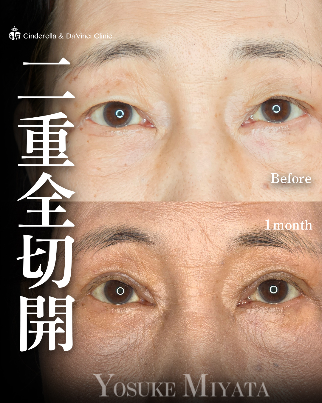 60代の全切開の画像