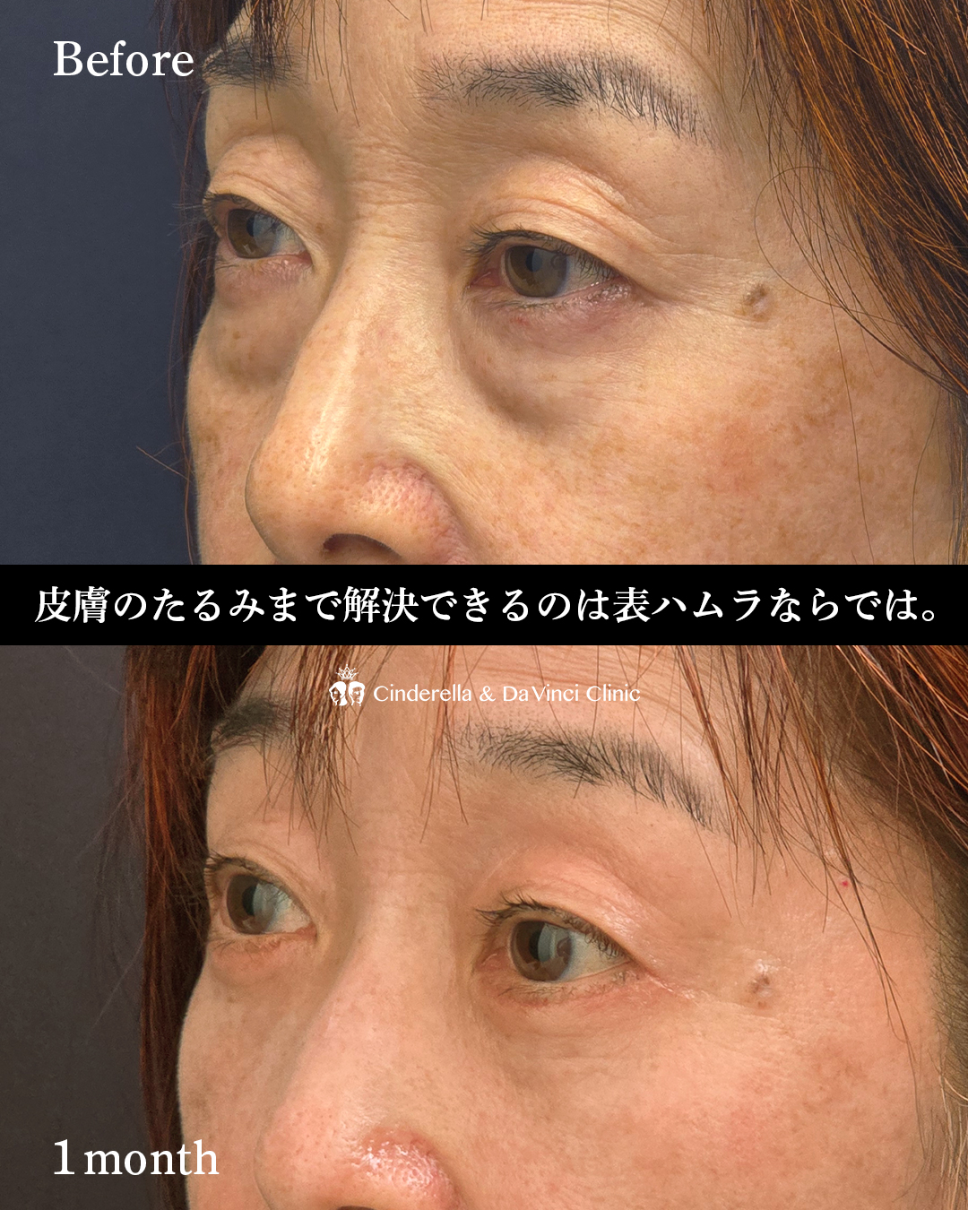目の下のたるみ取りの画像
