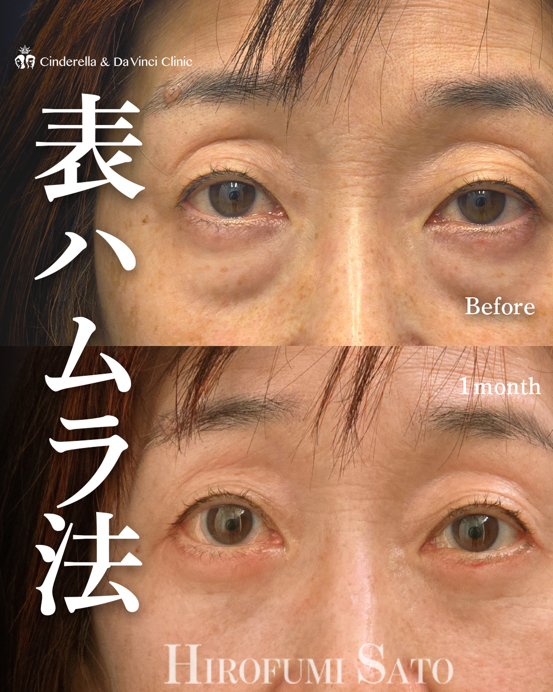 目の下のたるみ取りの画像