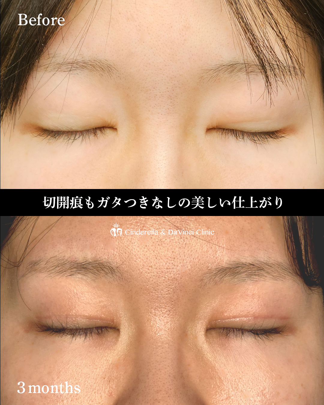 ナチュラルな全切開の画像