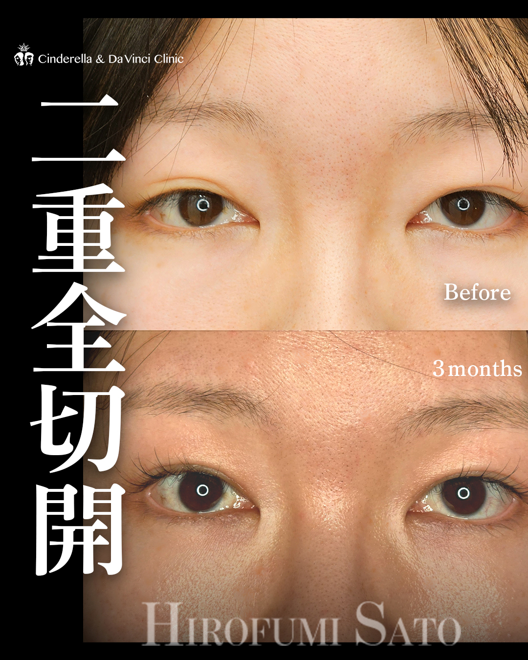ナチュラルな全切開の画像