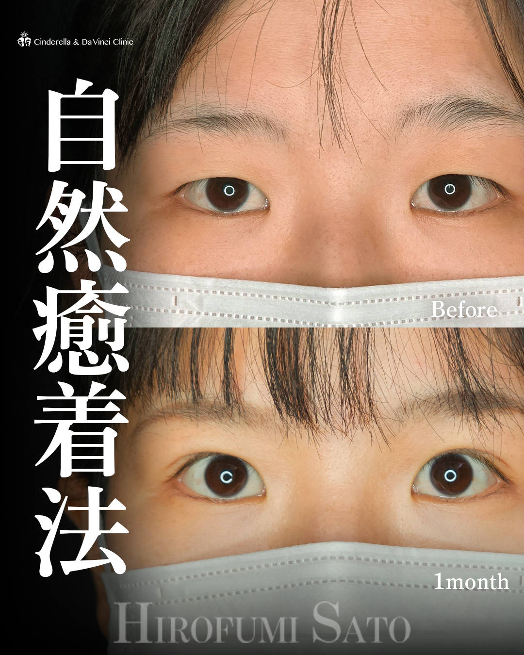ナチュラル二重の画像